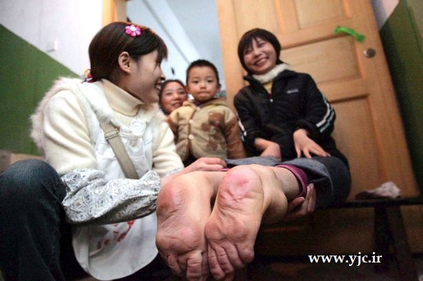 زندگی عجیب زنی با پاهای برعکس/عکس