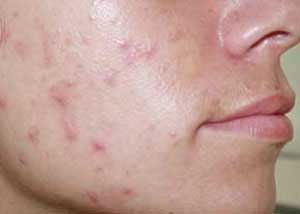 بیماری‌های پنهان که صورتتان را پر از جوش می‌کنند