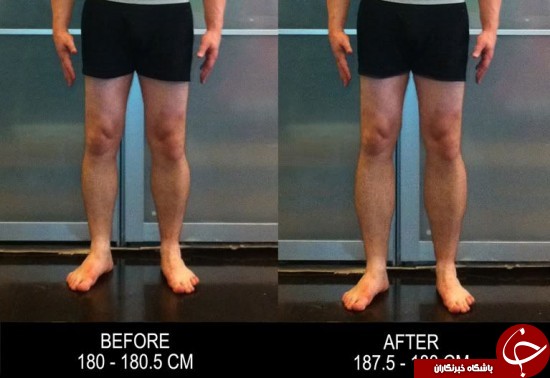عمل جراحی عجیب برای قدبلند شدن +عکس