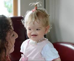 نوزادی که بینی ندارد +عکس