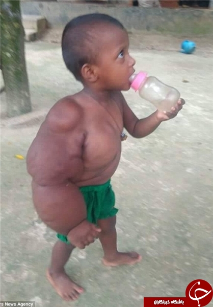 بیماری عجیب کودک 2 ساله که باعث طرد وی شده است +تصاویر