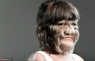 دختر تایلندی سوپاترا ساسوفان با توجه به روش اندازه گیری برای هیرسوتیسم در ۴ مارچ سال ۲۰۱۰ در یک برنامه رکورد در ایتالیا پر مو ترین نوجوان جهان شد.