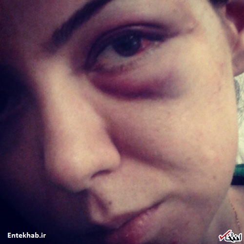 افشاگری آزاده نام‌داری از ضرب‌وشتم خود توسط فرزاد حسنی + تصویر