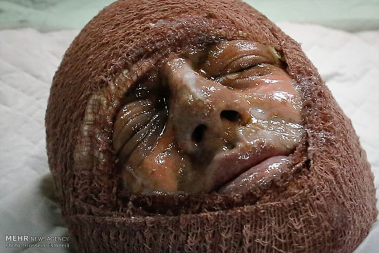 عکس: مصدومان چهارشنبه سوری در تهران