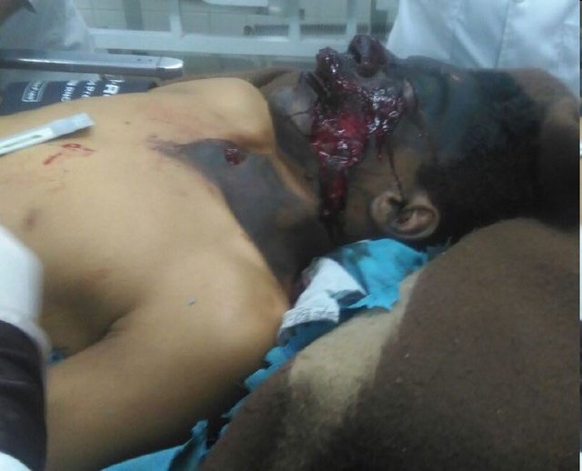 تصویری هولناک از سیاه شدن صورت نوجوان 13 ساله در اثر انفجار بمب